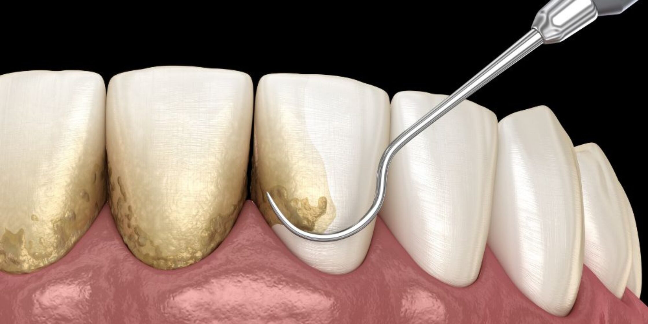 curetaje dental en Getxo