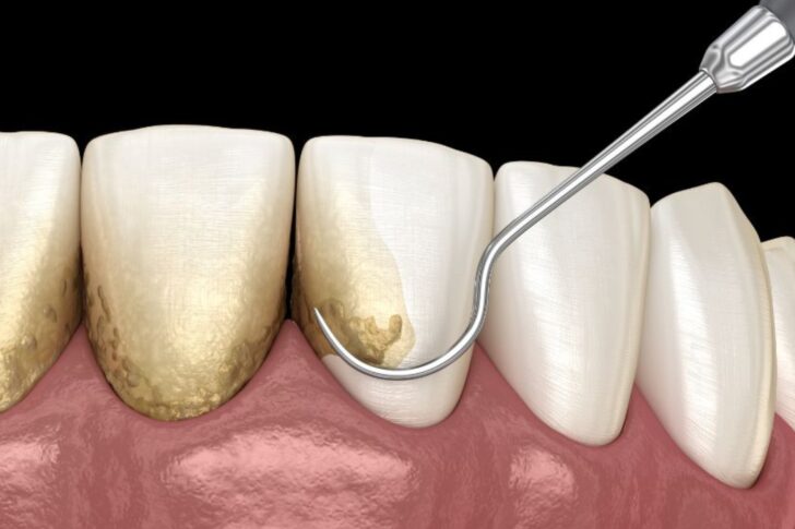 curetaje dental en Getxo