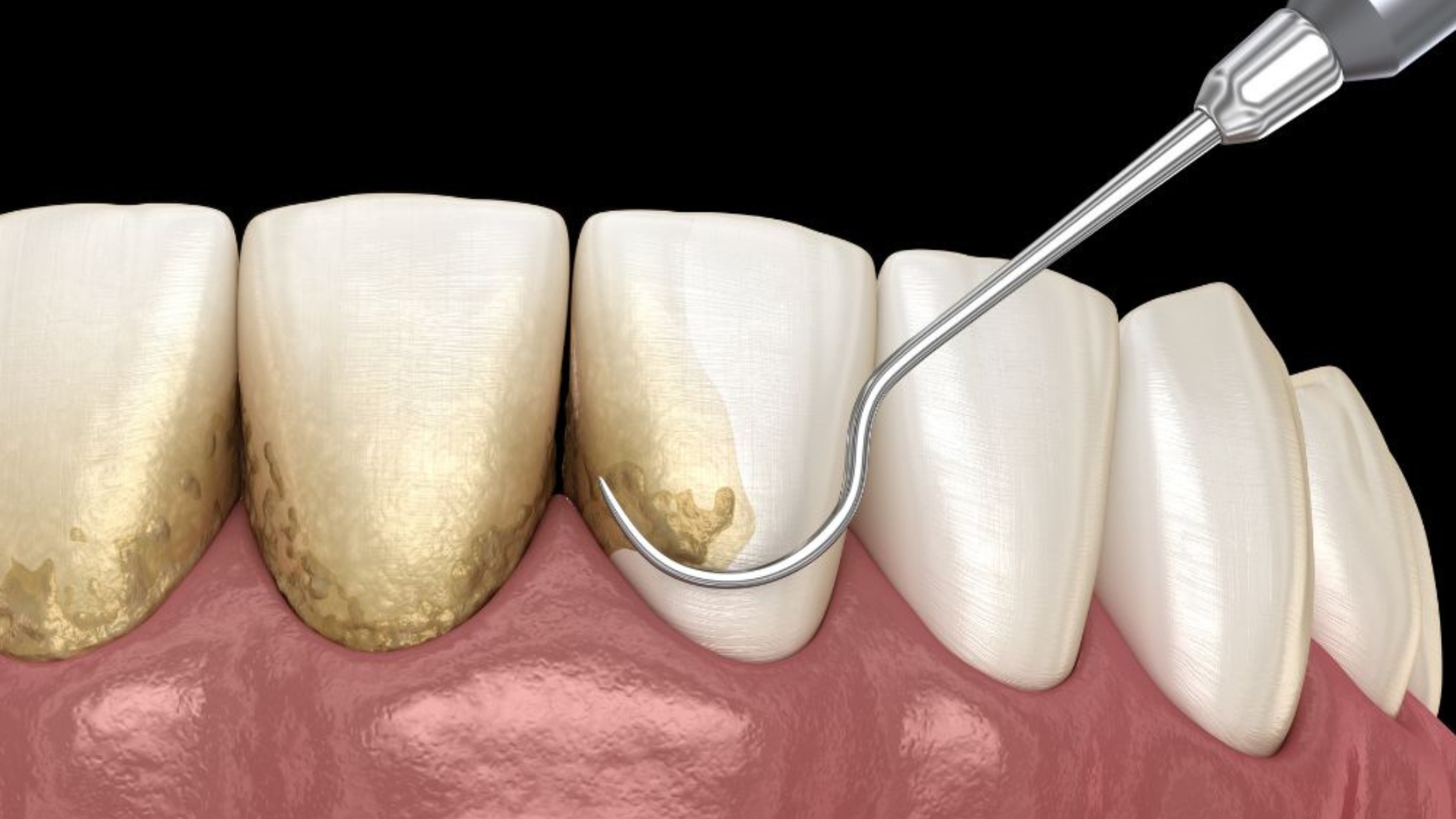 curetaje dental en Getxo