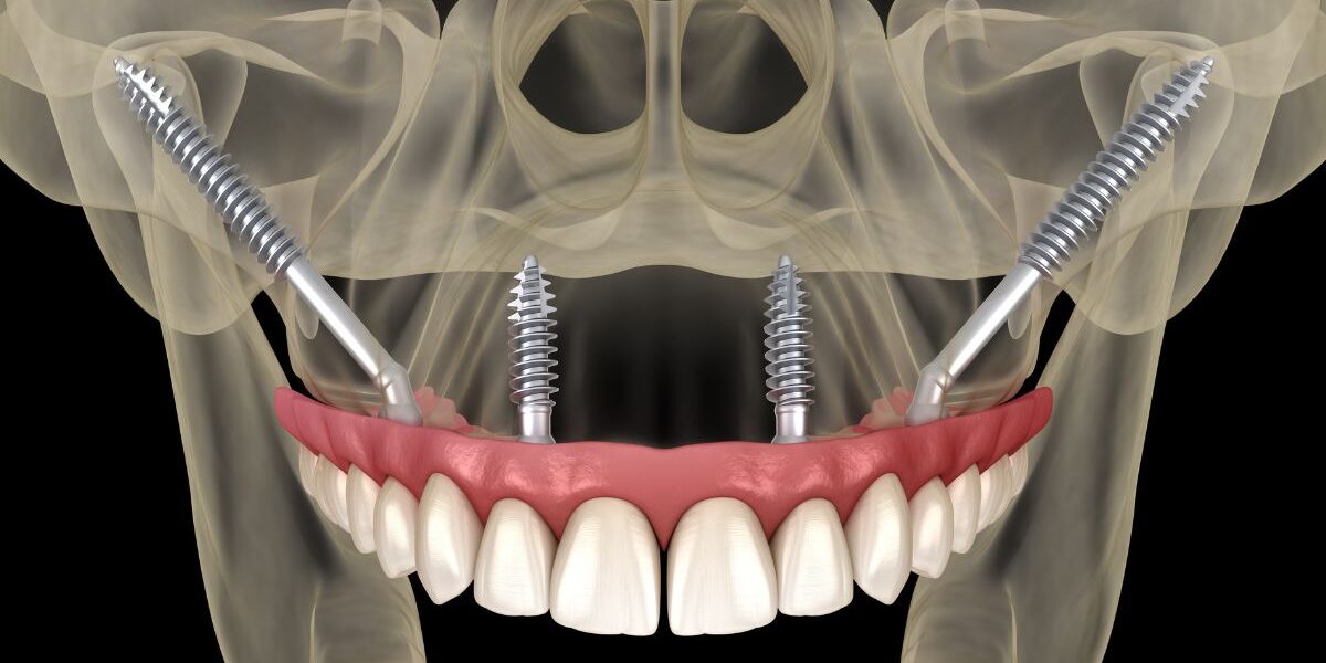 implantes cigomaticos