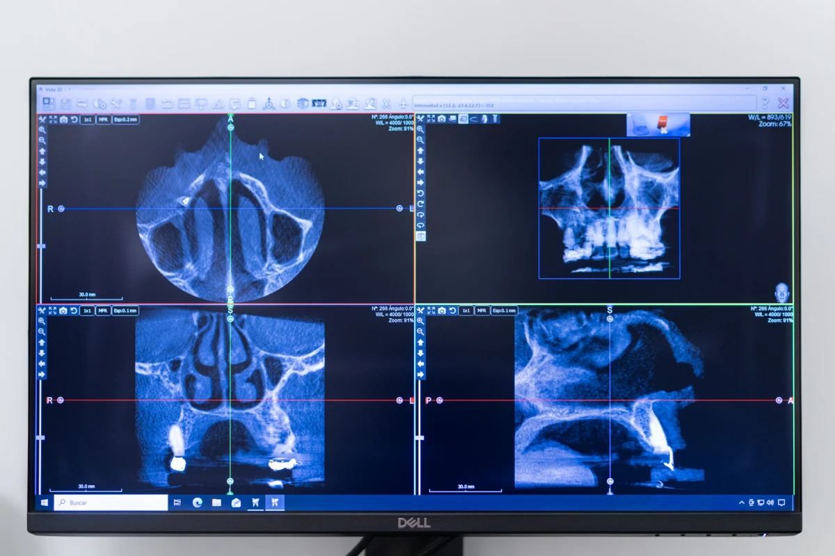 Planificación de implantes con escáner 3D (TAC dental) en Getxo